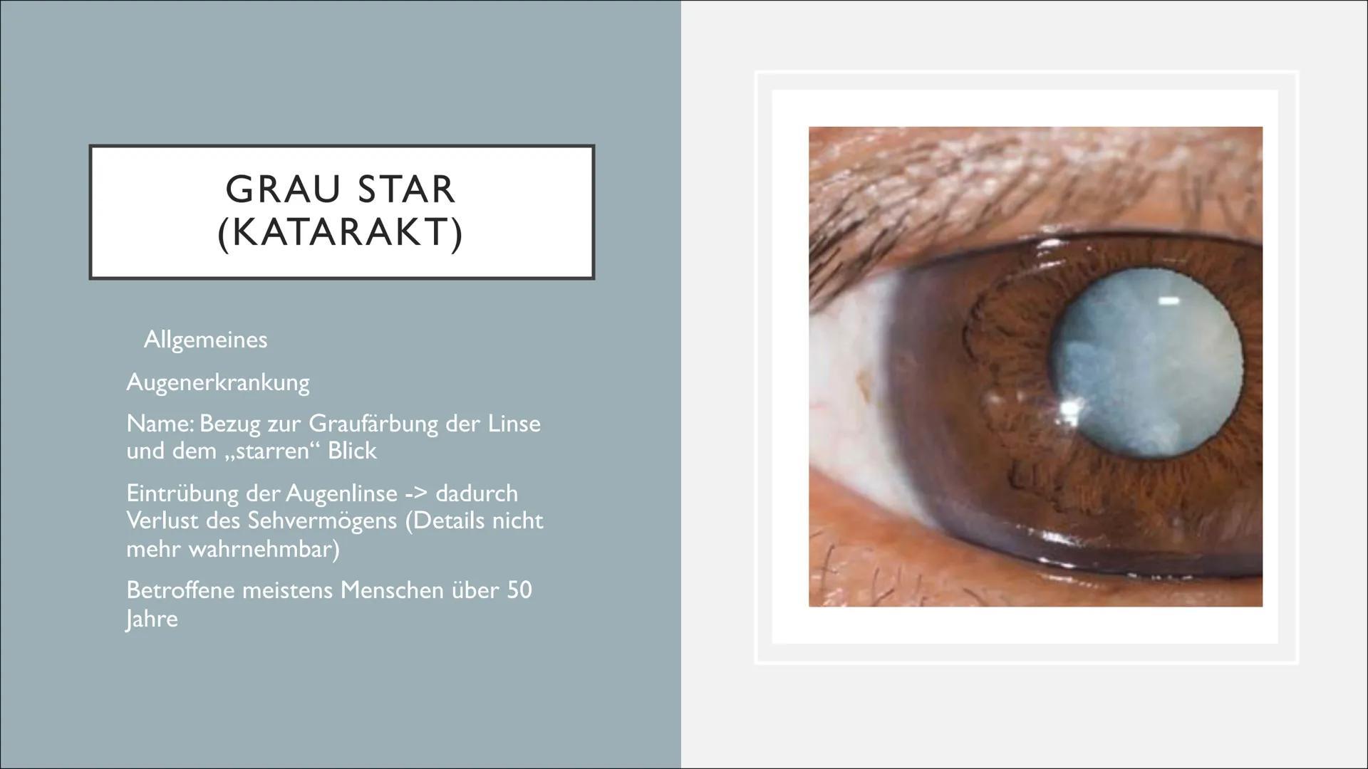 KRANKHEITEN UND
FEHLER DES AUGES
Von Lilith INHALTSVERZEICHNIS
1. Exkurs: Aufbau der Linse
2. Grau Star
3. Schielen
4. Grün Star
5. Weitsi