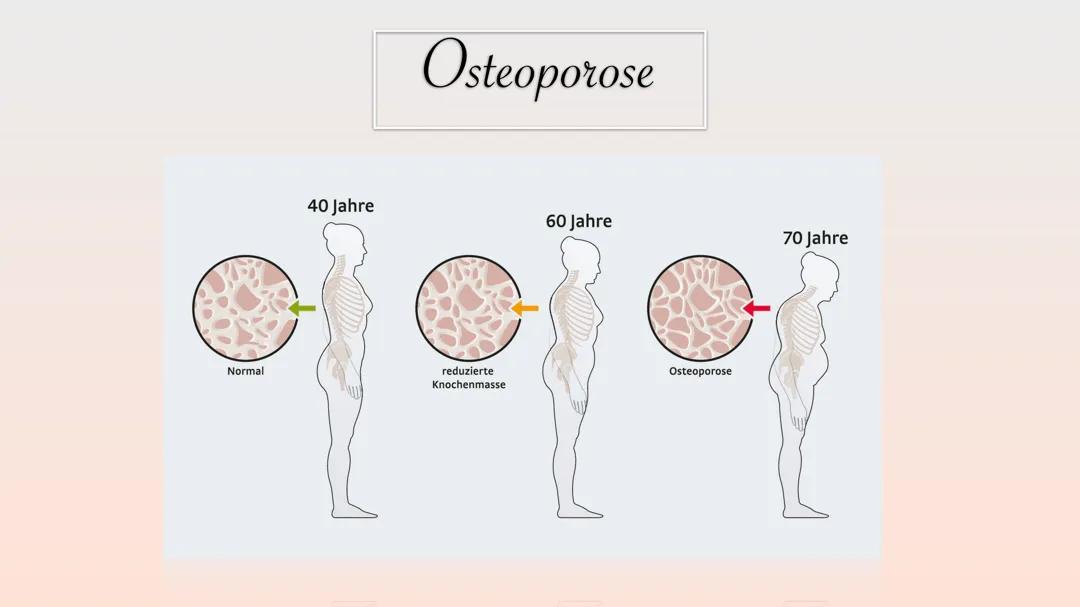 Osteoporose