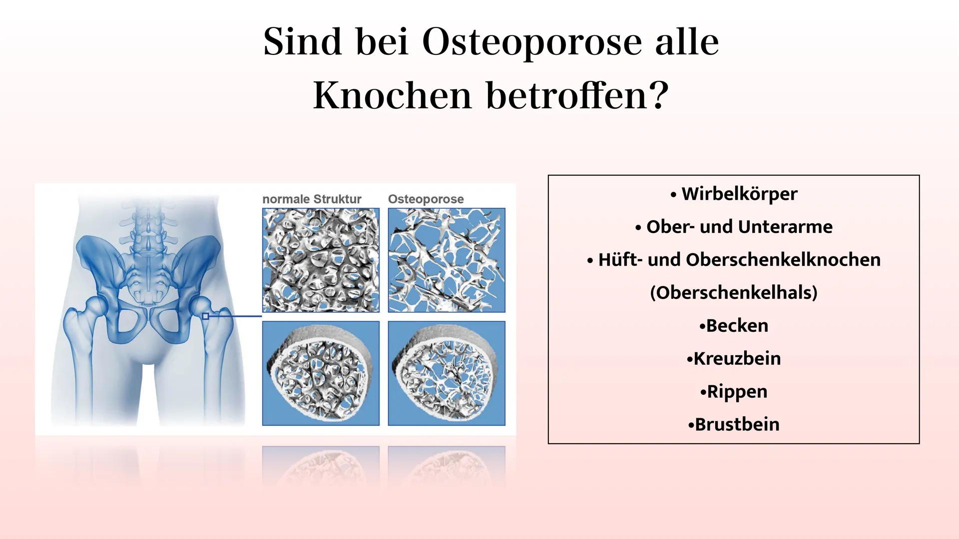# Osteoporose
40 jahre
Normal
60 jahre
reduzierte
Knochenmasse
70 jahre
Osteoporose Gliederung
• Definition
• Welche Knochen sind
be