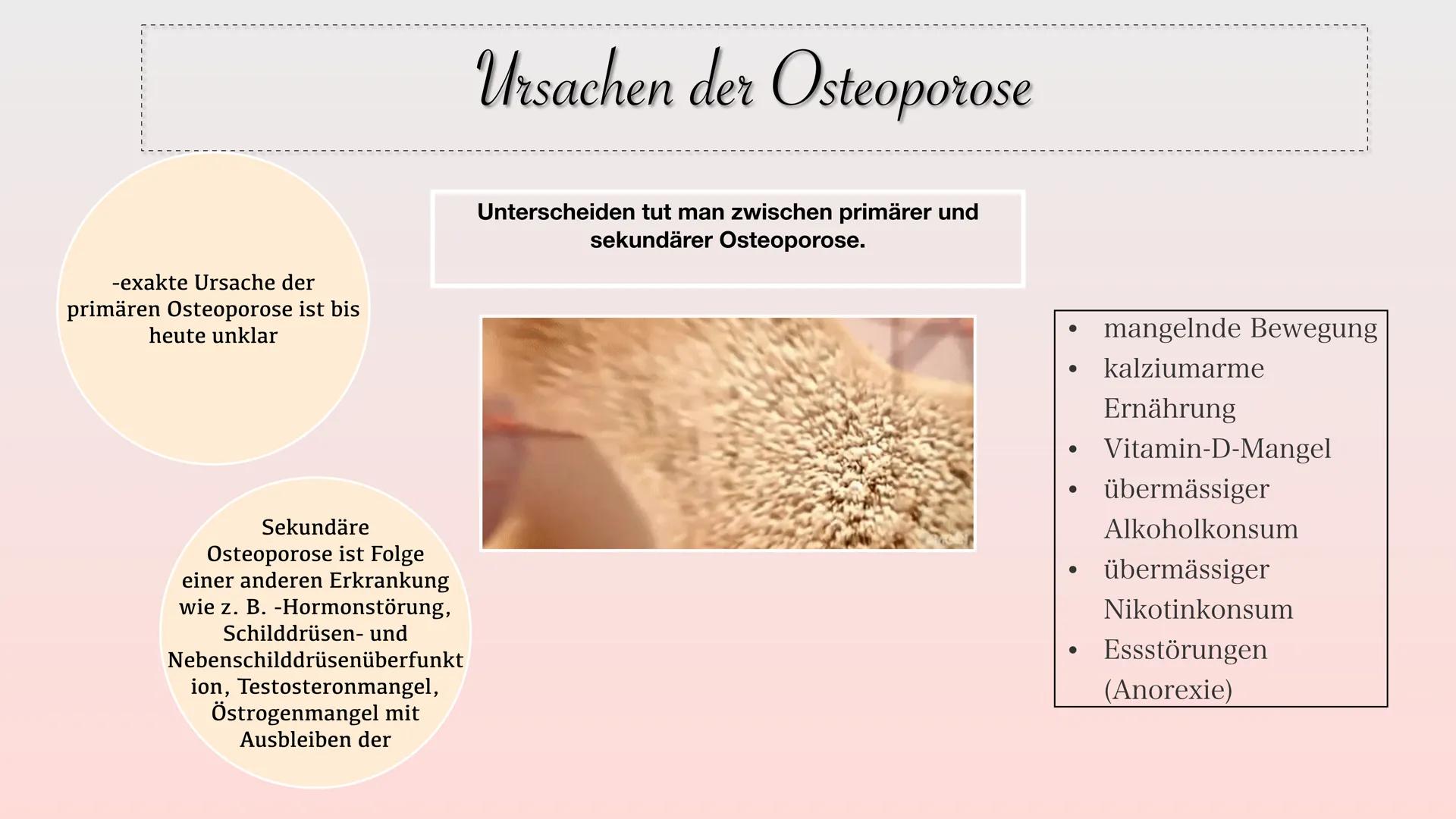 # Osteoporose
40 jahre
Normal
60 jahre
reduzierte
Knochenmasse
70 jahre
Osteoporose Gliederung
• Definition
• Welche Knochen sind
be